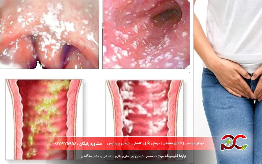 عکس انواع عفونت واژن