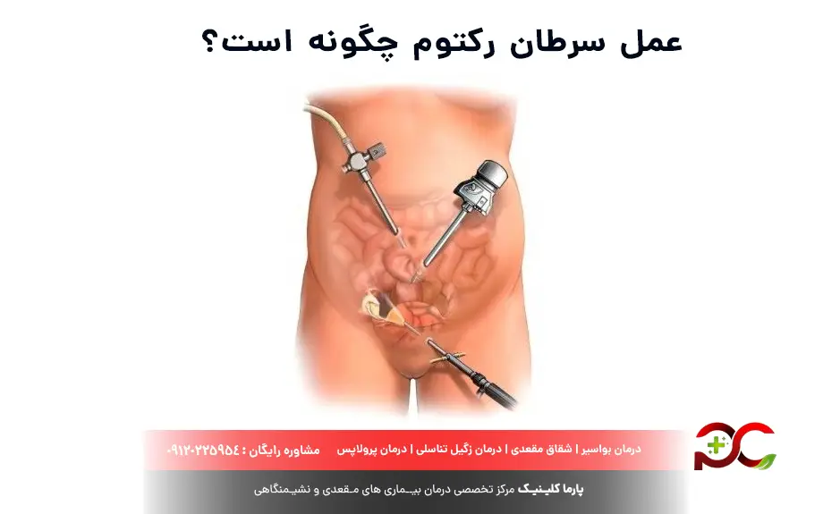 عمل سرطان رکتوم چگونه است؟