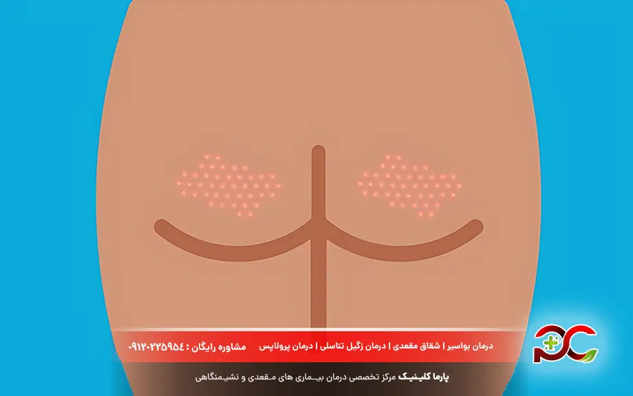 جوش مقعدی یا جوش آنال چیست؟ 