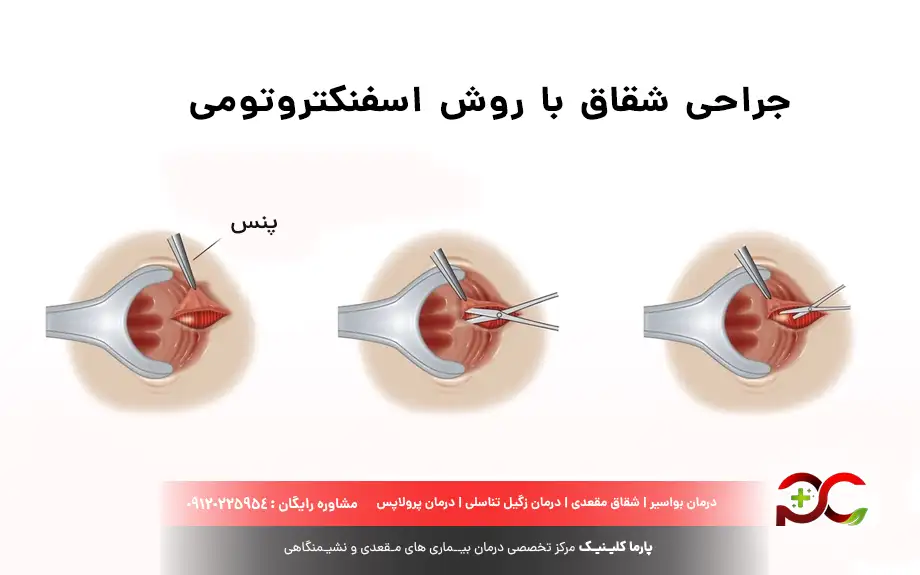 جراحی شقاق با روش اسفنکتروتومی