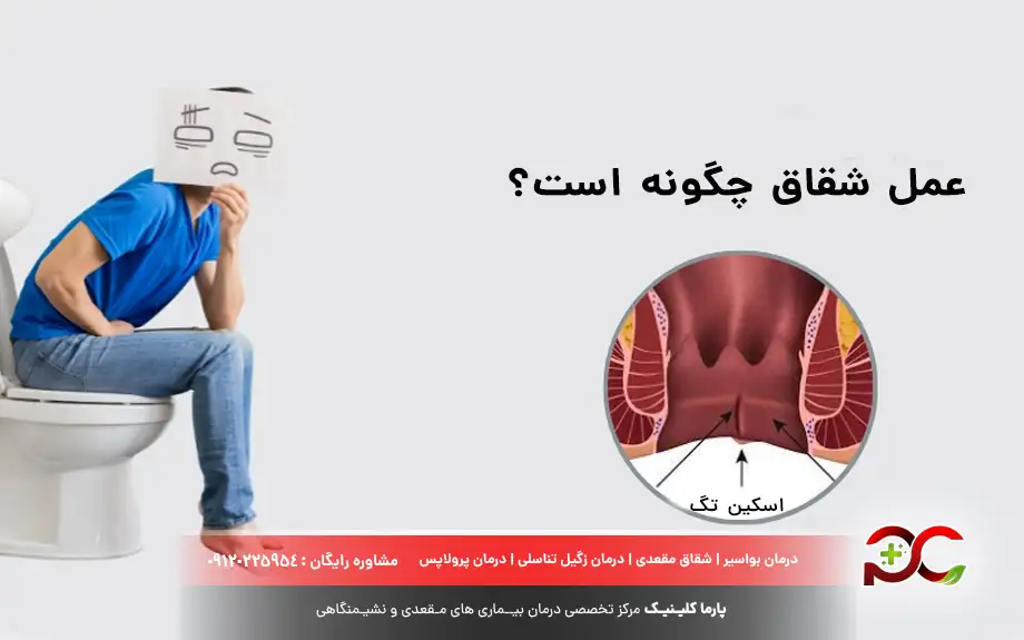 عمل شقاق چگونه است؟