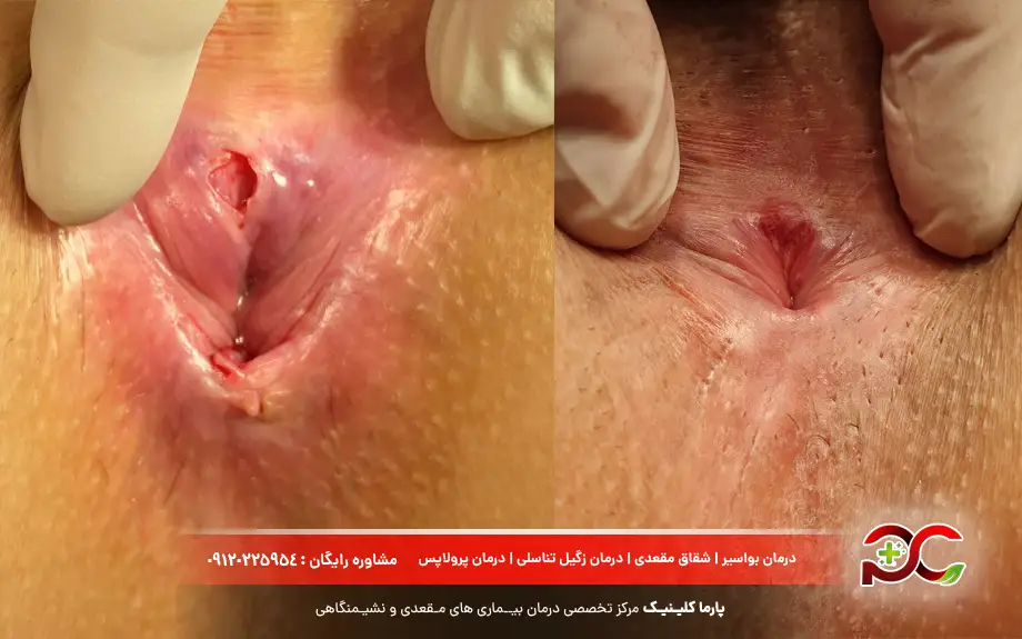 عکس شقاق بعد از عمل