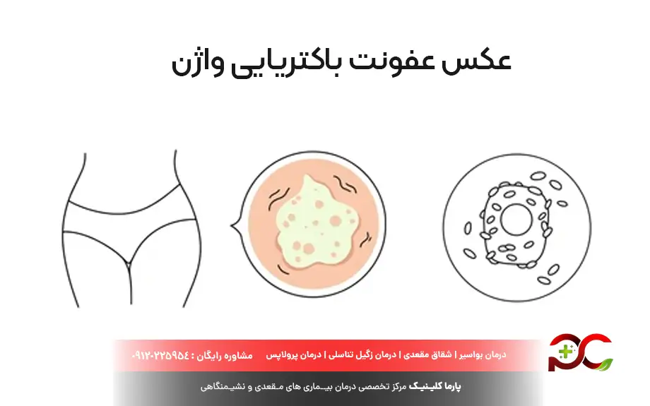 عکس عفونت باکتریایی واژن