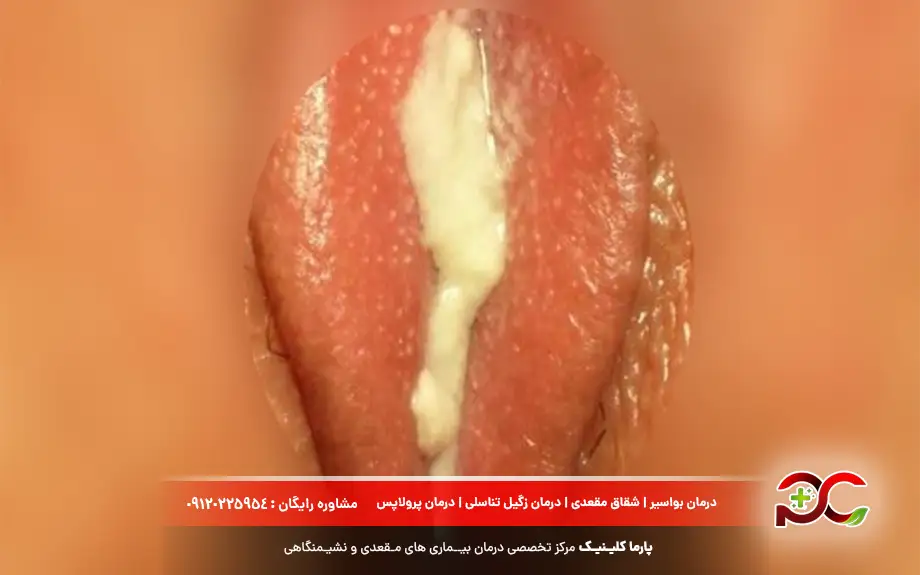 عکس عفونت قارچی واژن