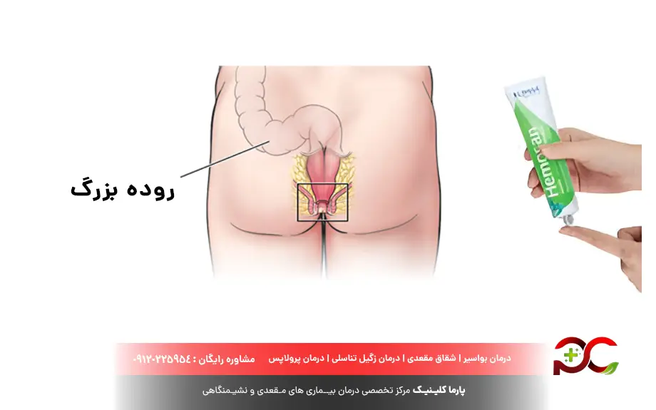 پماد دیلتیازم برای درمان هموروئید