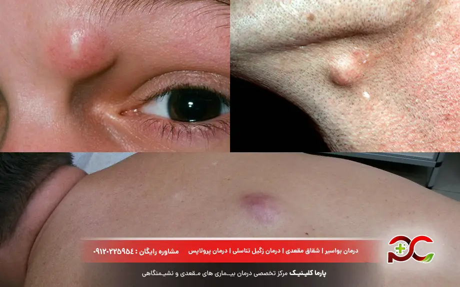 کیست سباسه چیست؟