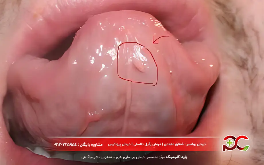 عکس زگیل دهانی خفیف