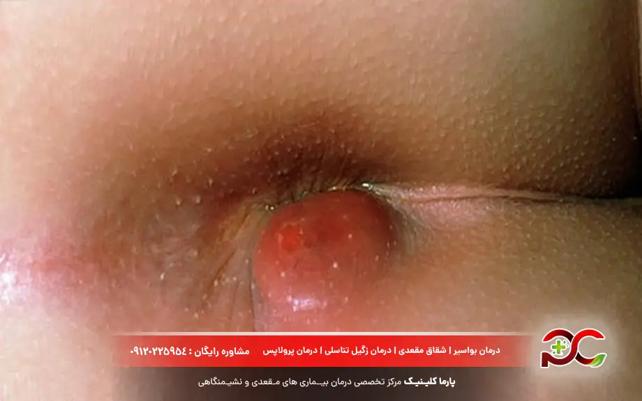 ورم مقعدی