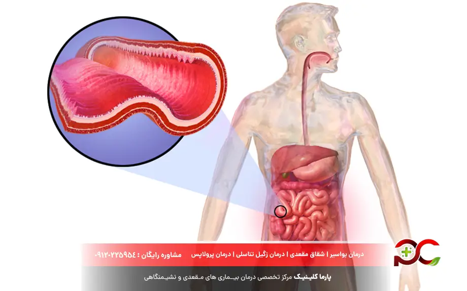 علت ورم مقعدی