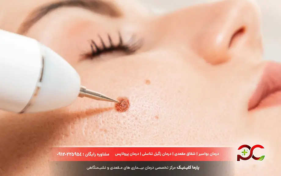 کرایوتراپی