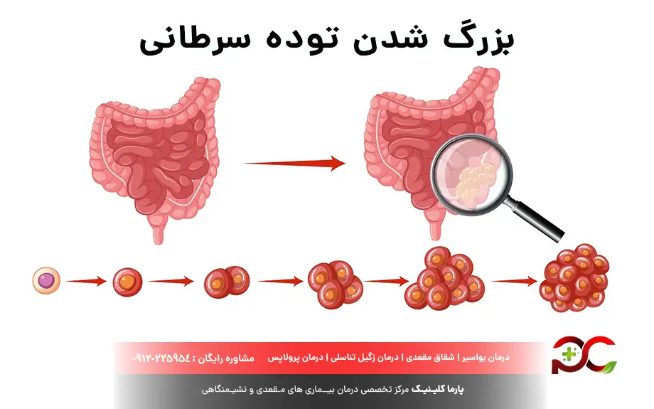 عکس سرطان مقعد + علت سرطان مقعدی چیست؟