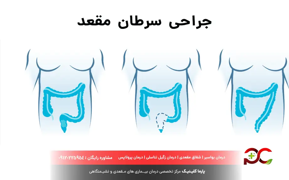 جراحی سرطان های مقعدی