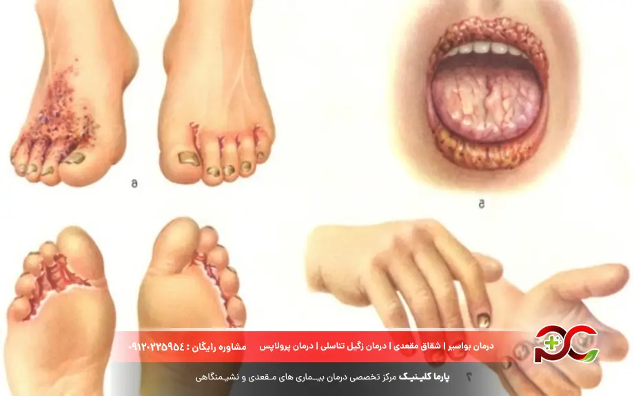 بیماری کلامیدیا