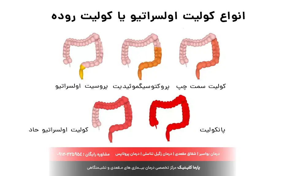 کولیت اولسراتیو