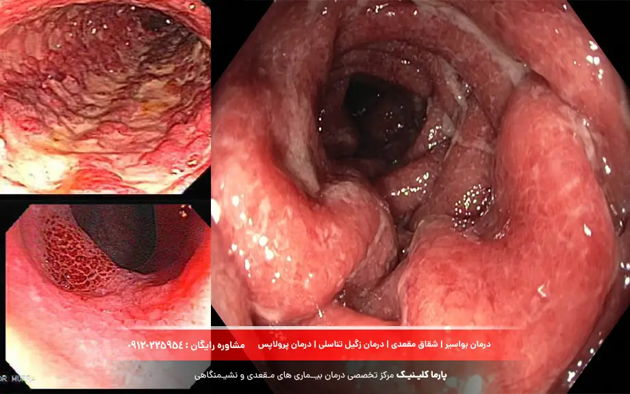 کولیت اولسراتیو چیست؟