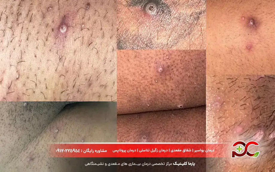 علائم مولوسکوم کنتاژیوزوم