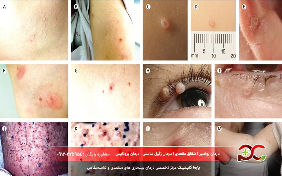 عکس زگیل آبکی