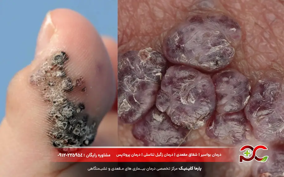 آنژیوکراتوم چیست؟