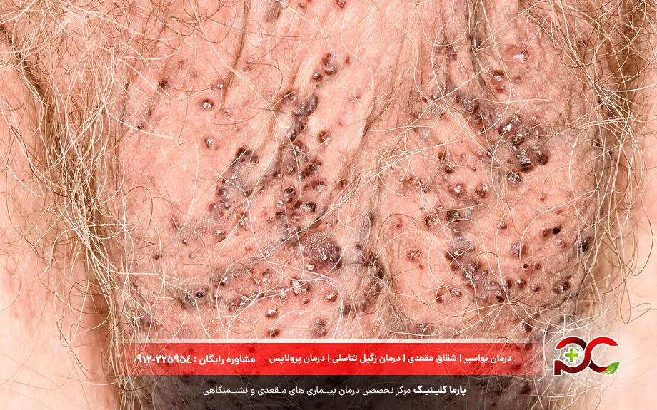 آنژیوکراتوم بیضه