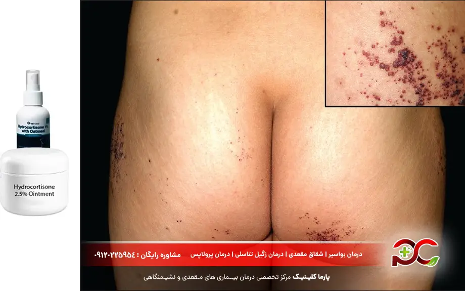 معرفی پماد برای آنژیوکراتوم