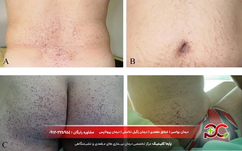 عوارض عدم درمان آنژیوکراتوم