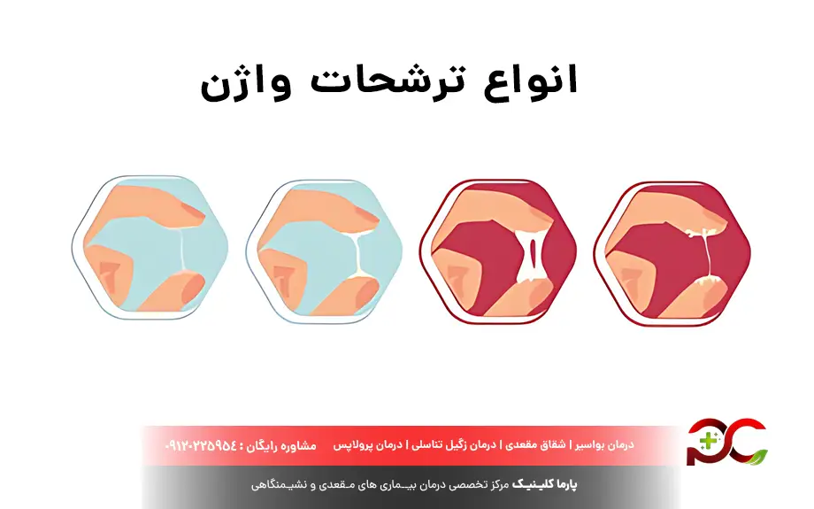 انواع ترشحات واژن
