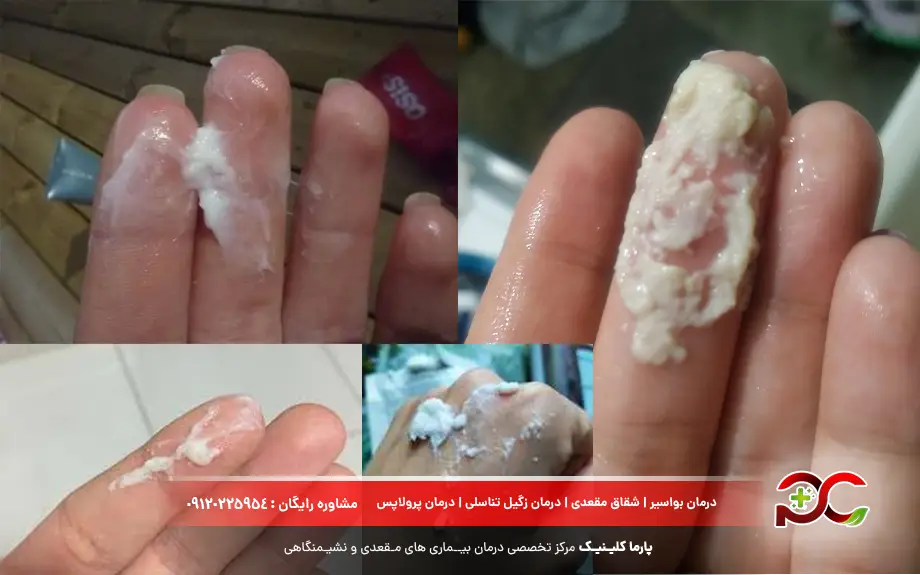 عکس ترشحات شیری رنگ واژن