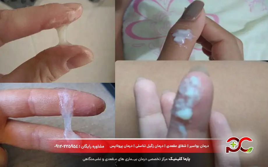 عکس ترشحات واژن