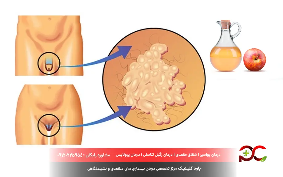 تشخیص زگیل تناسلی در خانه با سرکه
