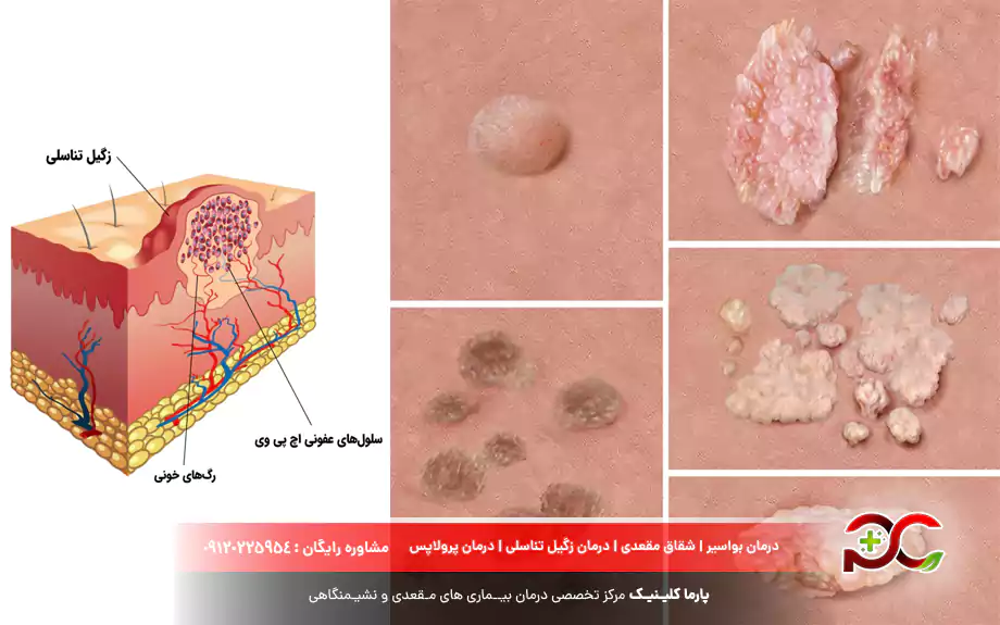 تشخیص زگیل تناسلی در خانه