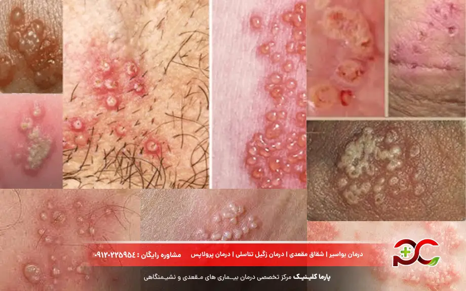 عکس تبخال تناسلی