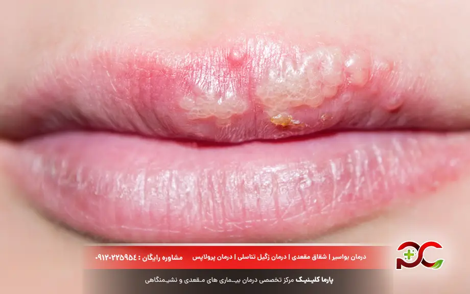 تبخال تناسلی در دهان