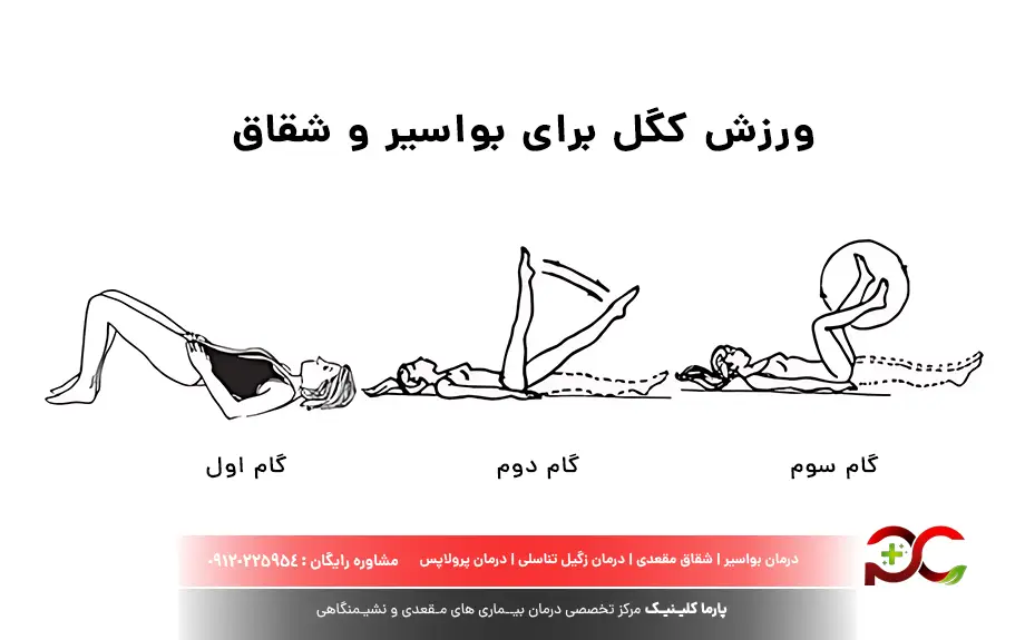 ورزش کگل برای بواسیر و شقاق