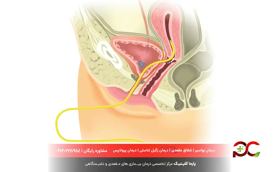 علائم فیستول رکتوواژینال