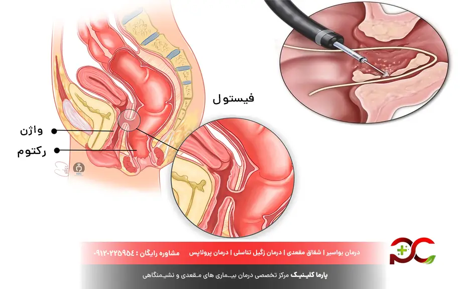 لیزر فیستول واژن