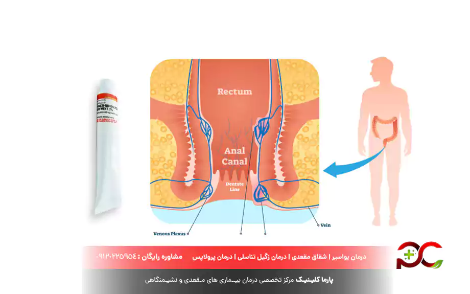 پماد نیتروگلیسیرین برای هموروئید