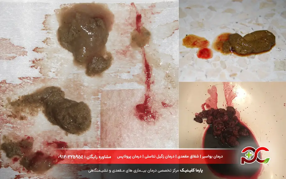 عکس اسهال خونی