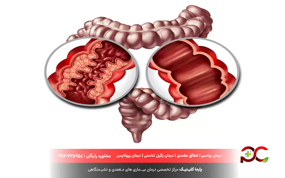 انسداد روده چیست؟