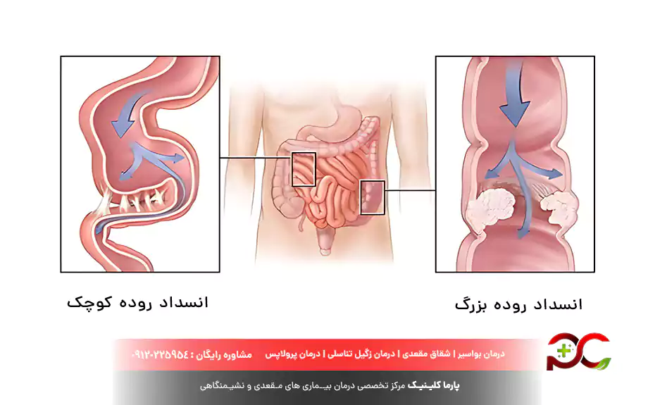انواع انسداد روده