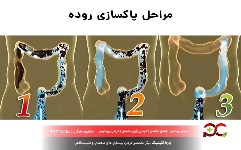مراحل پاکسازی روده
