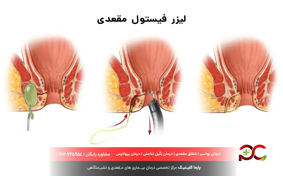 لیزر فیستول