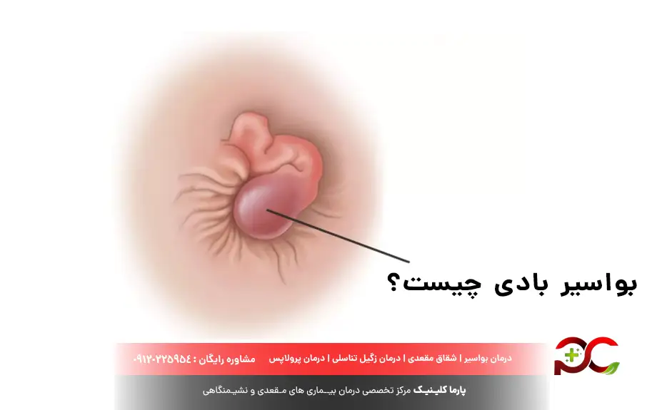 بواسیر بادی چیست؟