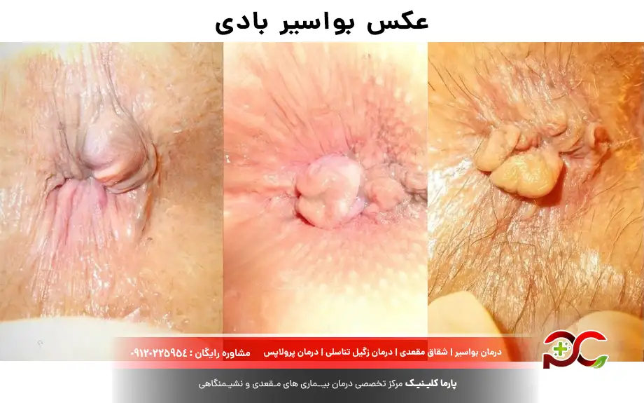 عکس بواسیر بادی 