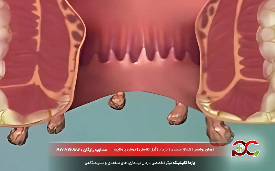 زگیل مقعدی چیست؟