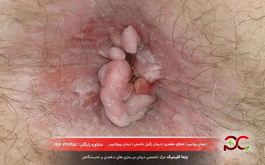 عکس زگیل مقعدی مردان