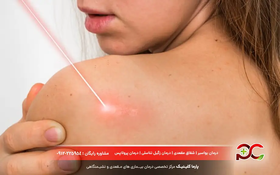 درمان زگیل مقعدی