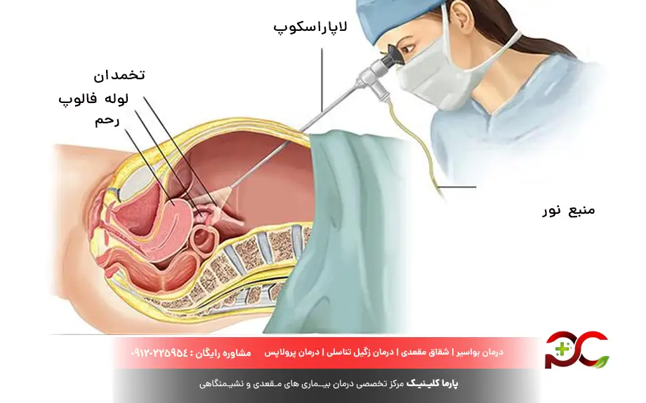 لاپاراسکوپی چیست