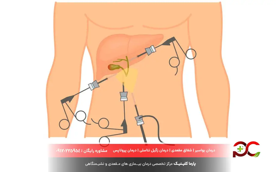 لاپاراسکوپی کیسه صفرا