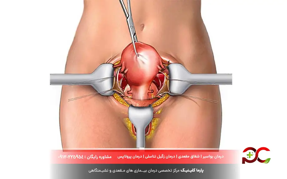 لاپاراسکوپی رحم چیست