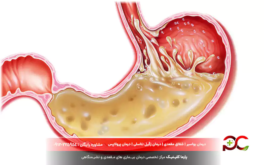 اسید معده چیست؟